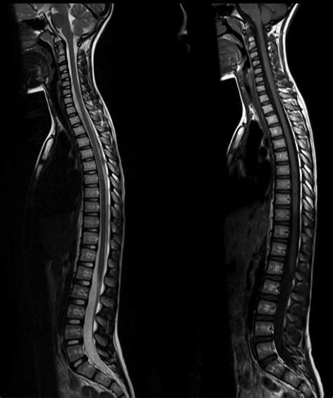 Normal Images of Spine - Joshua Li, MD, PhD