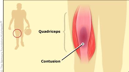 Quadriceps Contusion (for Teens) | Nemours KidsHealth