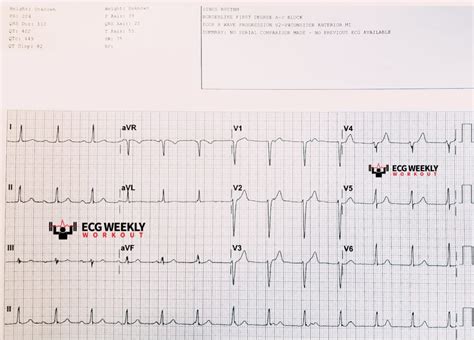 STAT ECG Diagnoses: isorhythmic AV dissociation and complete heart ...