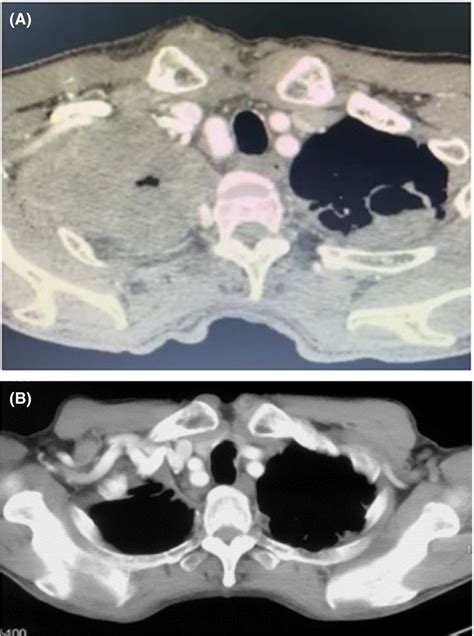 (A) The initial contrast‐enhanced CT thorax in September 2019 showed a ...