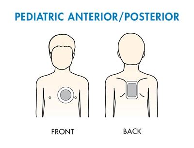 aed pad placement anteroposterior