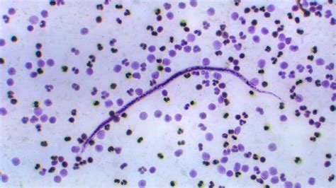 Clinical Treatment of Loiasis | Filarial Worms | CDC