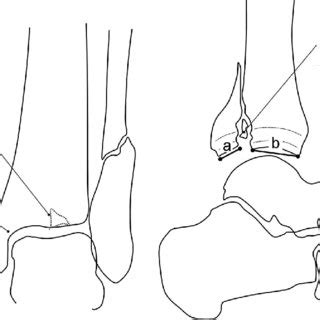 (PDF) Reliability of Radiologic Assessment of the Fracture Anatomy at ...