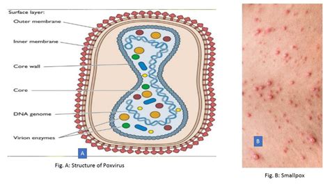 Poxvirus: History, Classification, Morphology, Pathogenesis, Laboratory Di