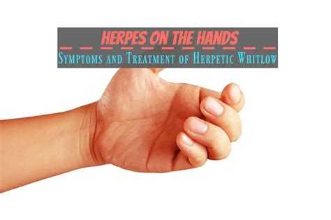 Herpes on the Hands: Symptoms and Treatment of Herpetic Whitlow - The ...