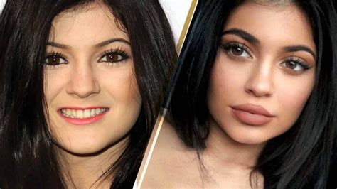 Kylie Jenner Before And After Plastic Surgery Photos