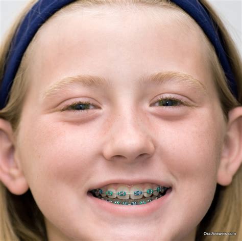 60 Photos of Teenagers with Braces | Oral Answers