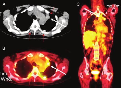 Pet Scan Images Lung Cancer