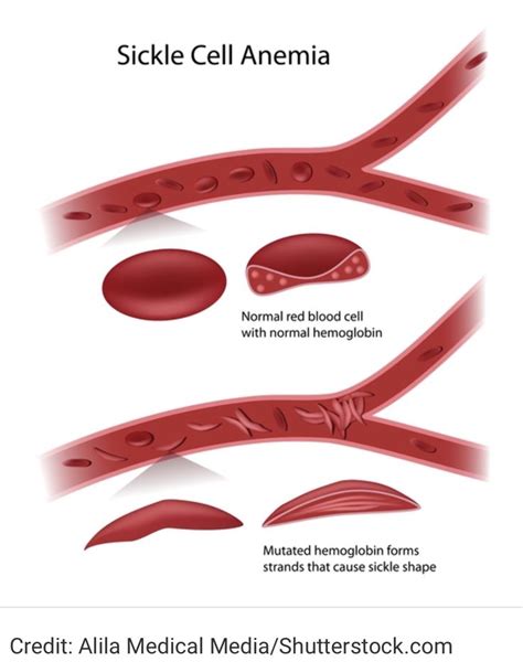 Pin on Sickle Cell Disease (SCD)