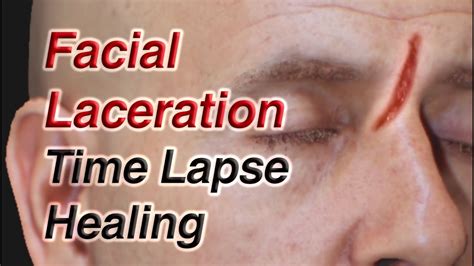 Facial Laceration Time Lapse Healing via Secondary Intention - YouTube