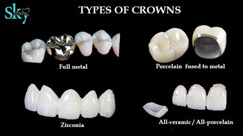 Types of Crowns - Sky Dental