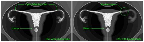 Hysterosalpingogram (HSG) test for Fallopian Tubes