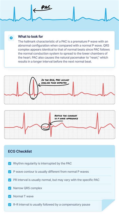 What Premature Atrial Contraction (PAC) Looks Like on Your Watch ECG | Qaly