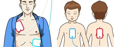 Automated External Defibrillator Pad Placement