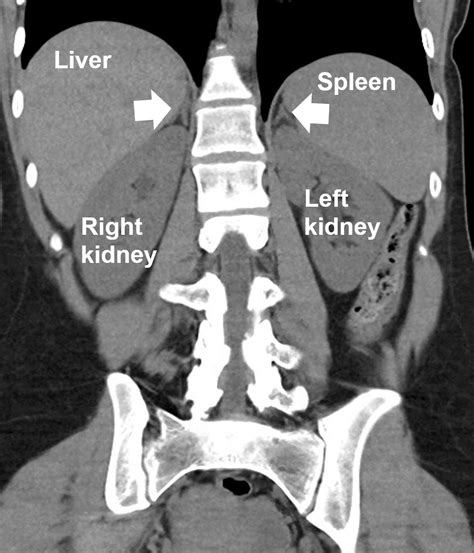 Anatomy of the Adrenal Glands: Where are Adrenal Glands and What do ...