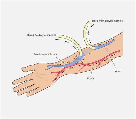 Arteriovenous Fistula (AVF) - CVSKL