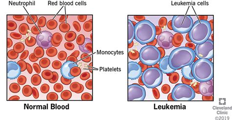 Leukemia Stem Cell Transplant - Stemcell Miami