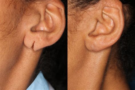 Earlobe Repair | Washington, DC | Center for Laser Surgery