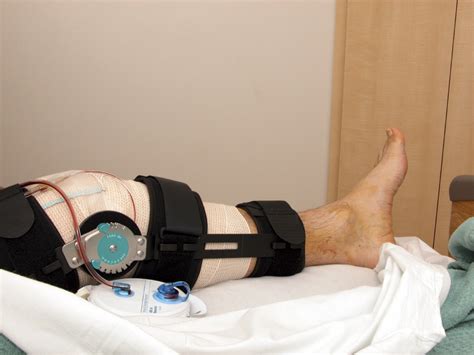 ACL Surgery Recovery Timeline | OSG