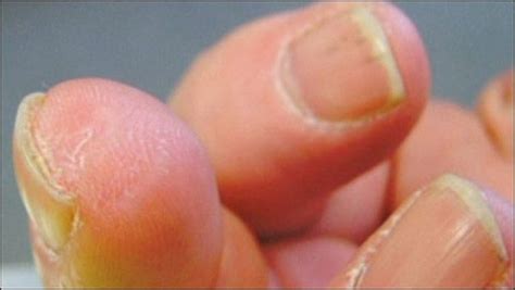 Scientists Discover Miracle Powder, Regrow Man's Severed Finger ...