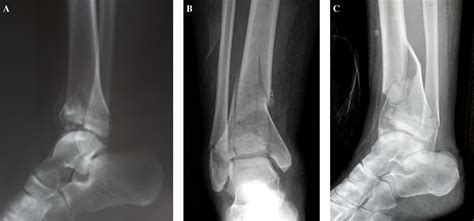 Tibial Plafond