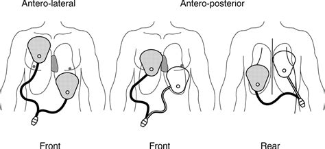 External cardioversion of atrial fibrillation: role of paddle position ...