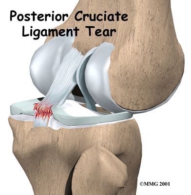 (PCL) Posterior Cruciate Ligament Tear Symptoms & Treatment