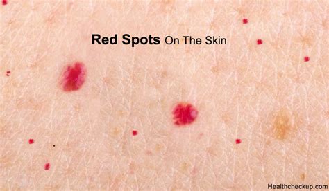 Red Spots On Skin Cancer