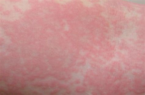 Allergy Reaction Rash - Pictures, Treatment, Causes, Symptoms | Med Mum