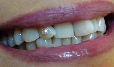 DIAMONDS ON TEETH AHMEDABAD, TOOTH JWELLERY, TOOTH CRYSTALS LAMINATES ...