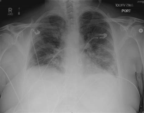 This is what can happen to your lungs when you have coronavirus ...