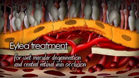 Eylea for macular degeneration and retinal vein occlusion