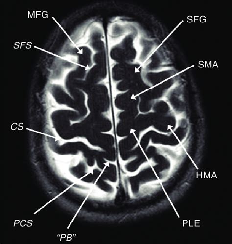 Axial T2-weighted MRI showing the middle frontal gyrus (MFG), superior ...