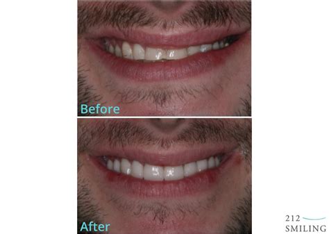 Veneers Before and After Male - 212 Smiling