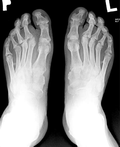 X-ray of feet: The destructive form of psoriatic arthritis (arthritis ...