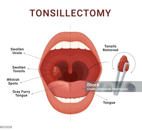 Tonsillectomy Scheme Removal Of Palatine Tonsils Acute Pharyngitis ...