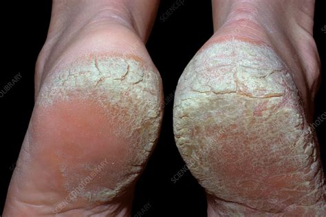 Plantar psoriasis - Stock Image - C037/2755 - Science Photo Library