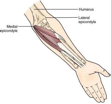 Forearm Tendinitis | Musculoskeletal Key