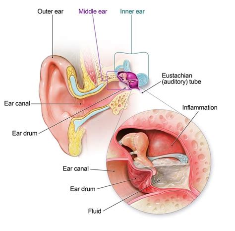 Ear Discharge (Ear Drainage) - Symptoms And Best Treatment