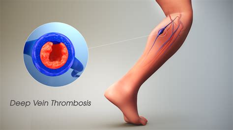 Deep Vein Thrombosis (DVT): Symptoms, Causes, and Treatment