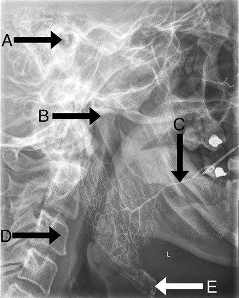 Diagnostic parotid sialogram | The BMJ