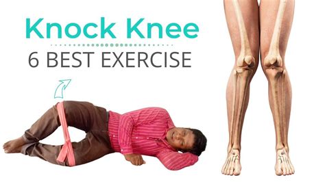 Knock Knees Exercises, Knee Exercises, Knock Knees Correction, Weight ...