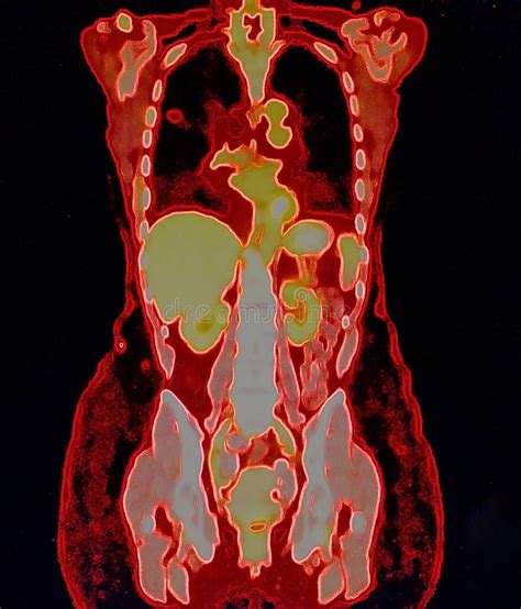 What Is A Pet Ct Scan For Cancer