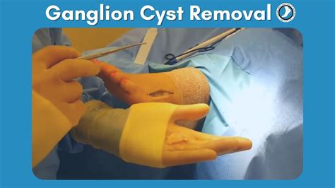 What Is A Ganglion Cyst Ganglion Cyst Removal Without Surgery Images ...