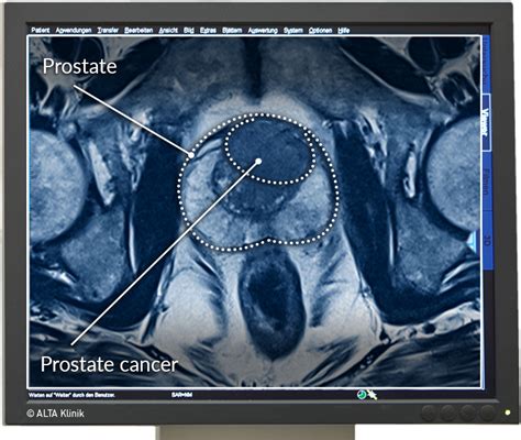 Multiparametric MRI of the Prostate - ALTA Klinik