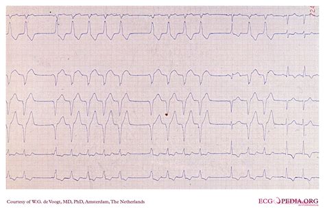 Atrial fibrillation with LBBB EKG examples - wikidoc