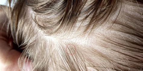 What To Do If My Baby Has Lice? | LiceDoctors