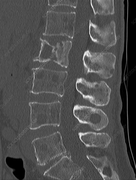 Secondary bone cancer in the spine, CT scan - Stock Image - C033/7534 ...