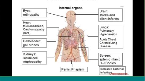 Describe the Symptoms of Sickle Cell Anemia - HarrykruwPerez