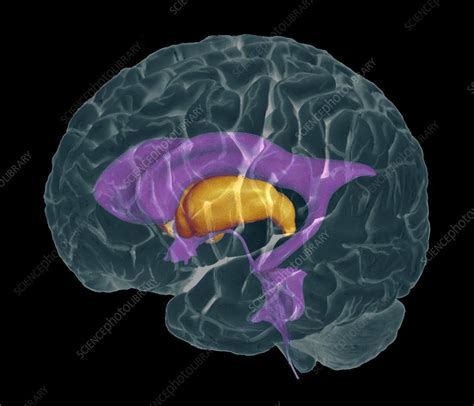 Brain ventricles, coloured CT/MRI scan - Stock Image - P330/0333 ...